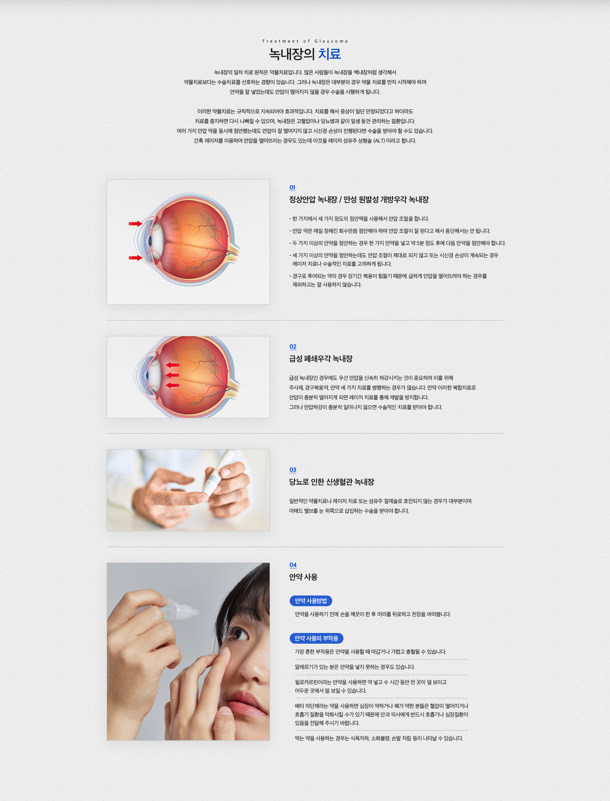 녹내장 치료